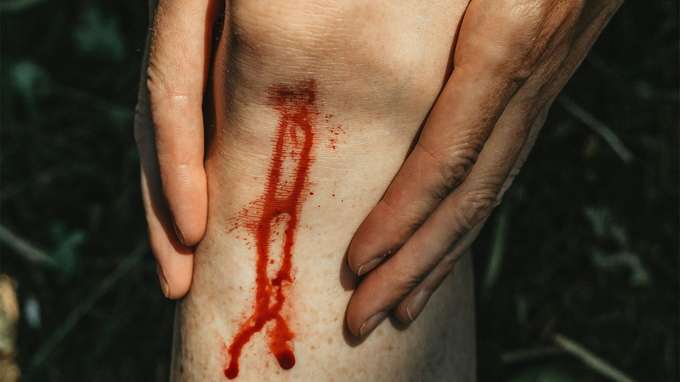 Eine Sepsis kann durch eine entzündete Wunde entstehen, aber auch aus Infektionen hervorgehen, die zunächst harmlos erscheinen | © AOK Baden-Württemberg